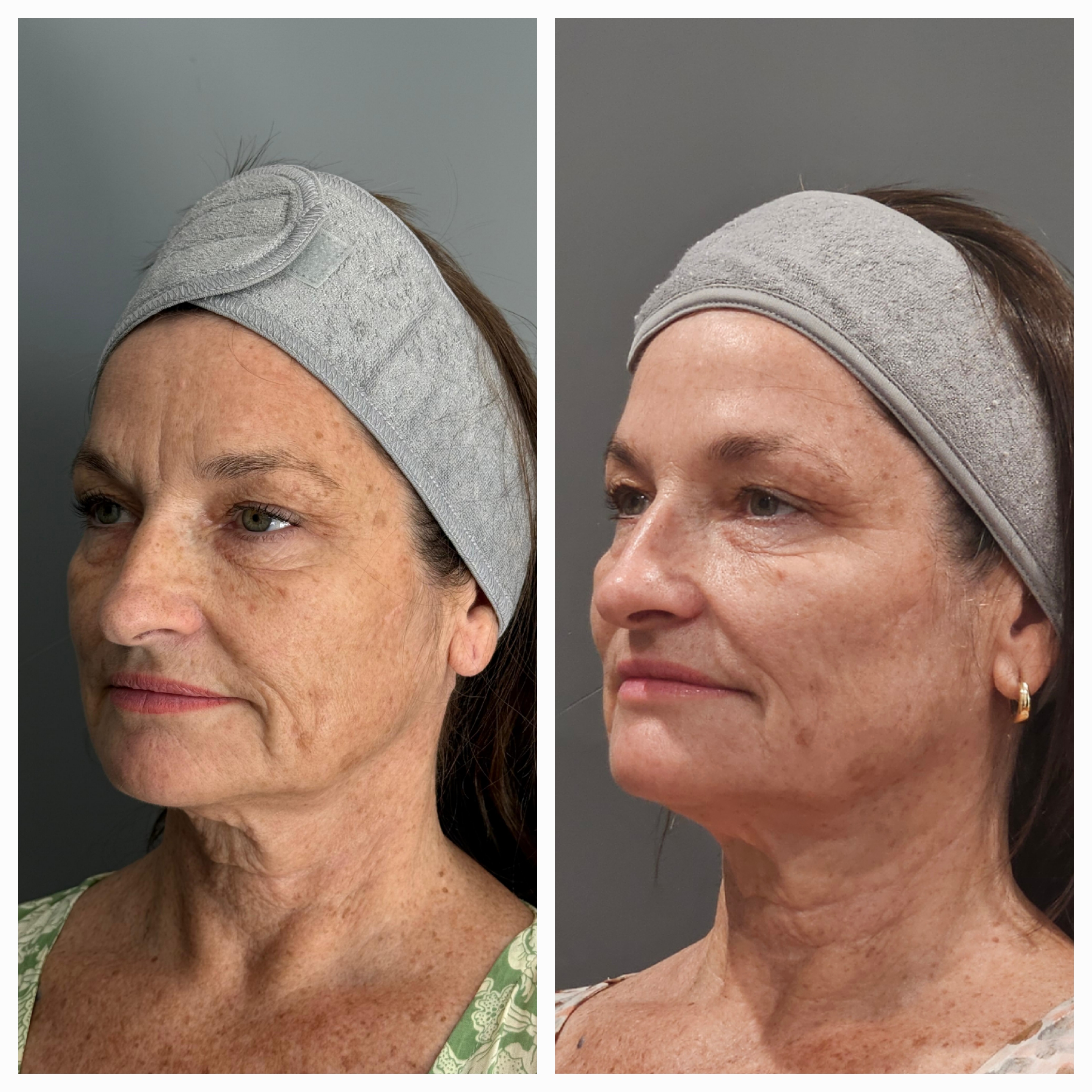 EXION HA Boost Face before and after — before on the left, after on the right